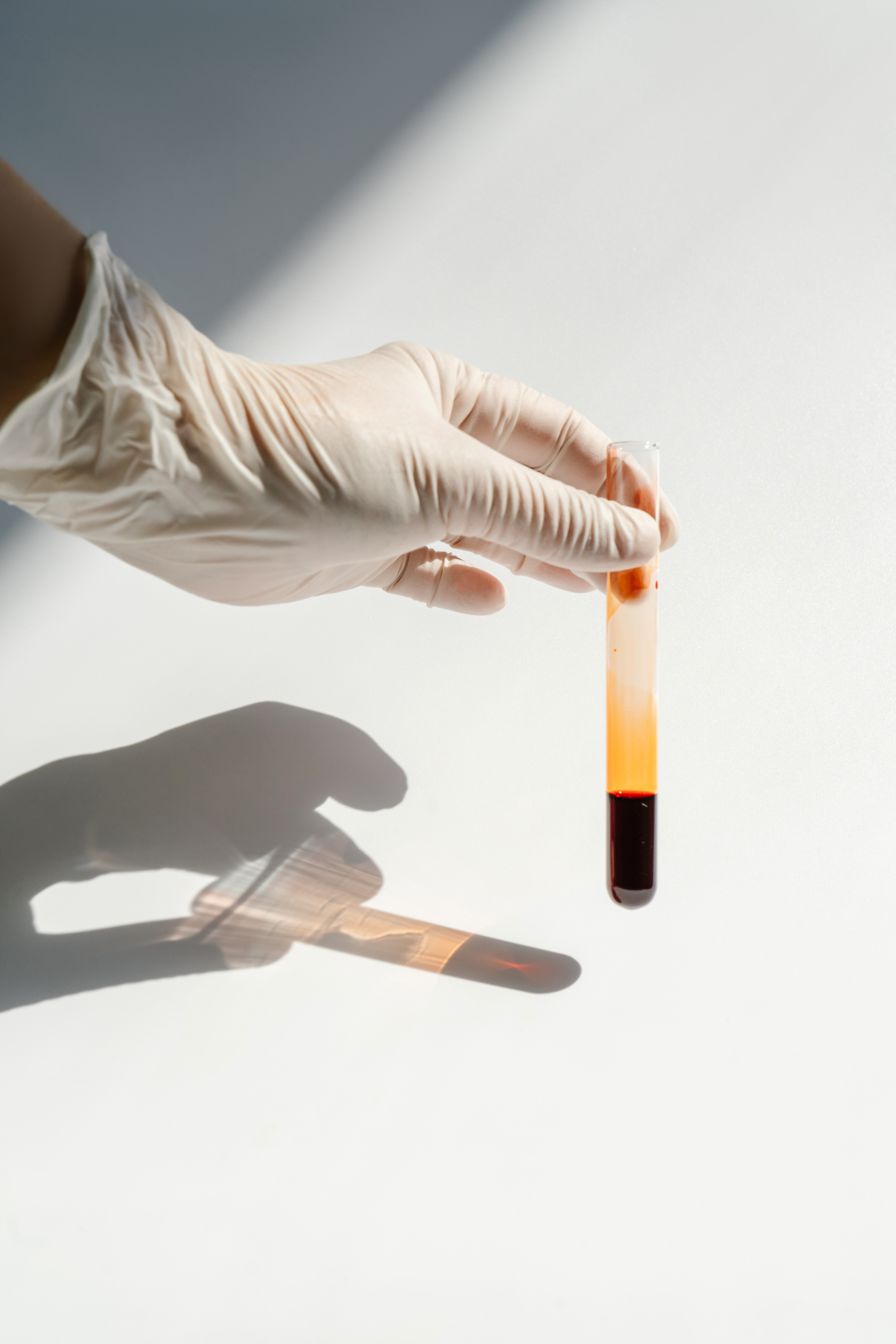 Platelet-Rich Plasma (PRP)
